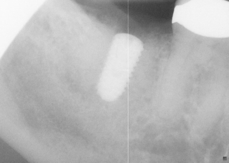 Implant in Place