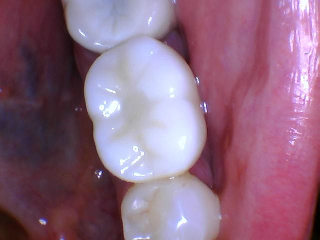 New molar tooth placed on top of implant.