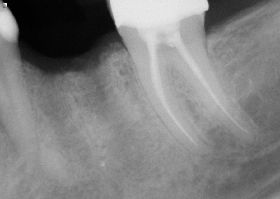 Missing molar tooth with good bone.