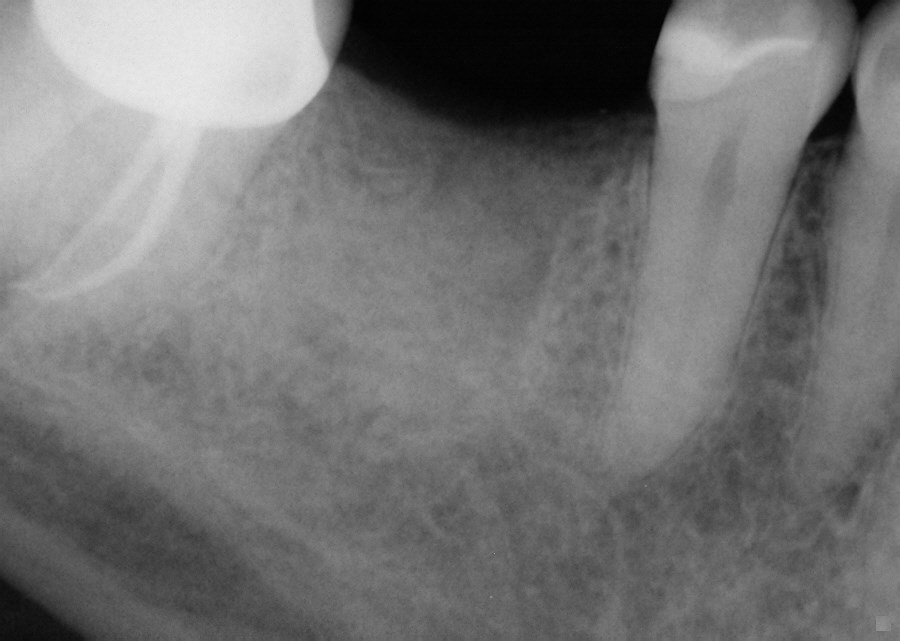 Missing molar tooth with good bone.