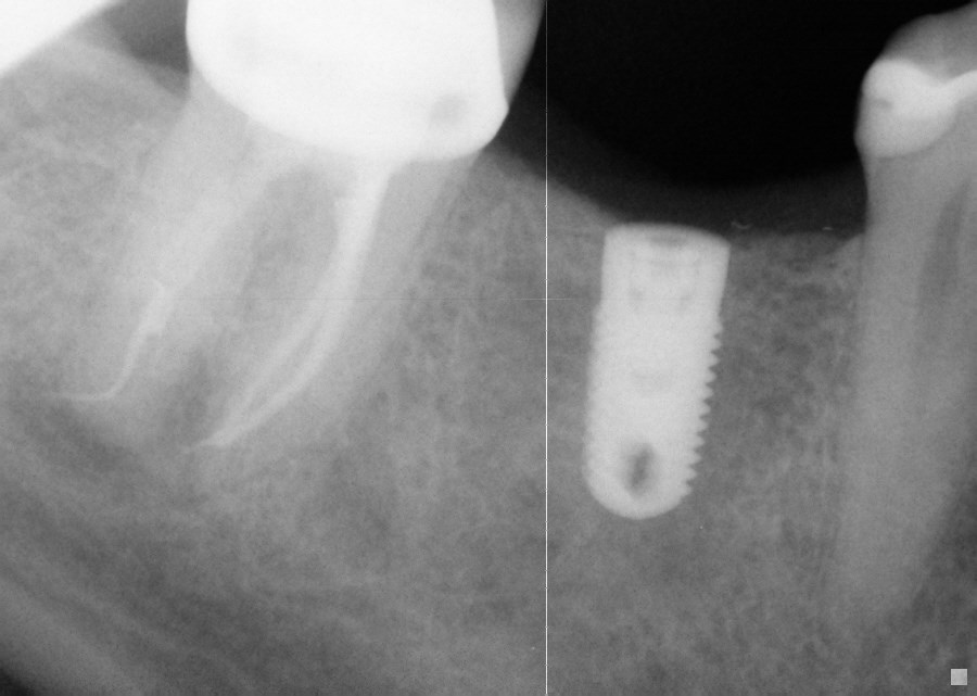 Implant placed where molar tooth was lost.